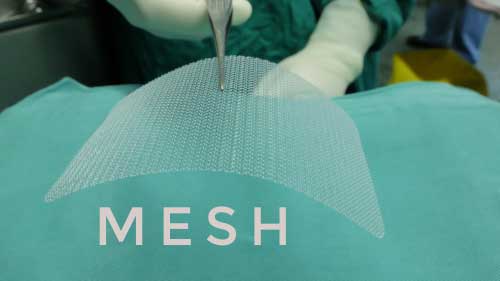 File your Atlanta hernia mesh lawsuit with our attorneys today.