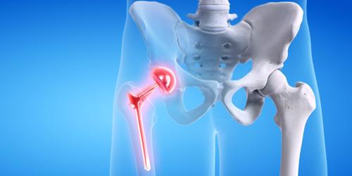 Contact our firm to file your Phoenix hip replacement lawsuit.