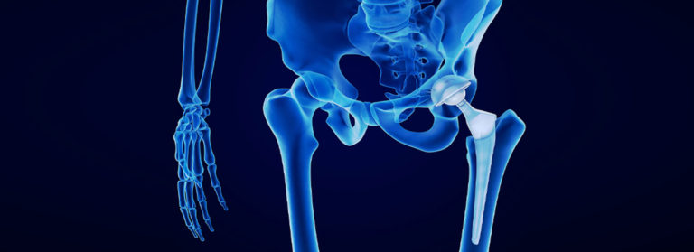 Hip Replacement Lawsuits