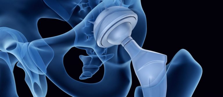 hip implant lawsuits